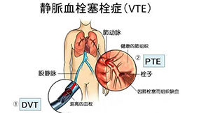 腎病綜合癥的VTE預防