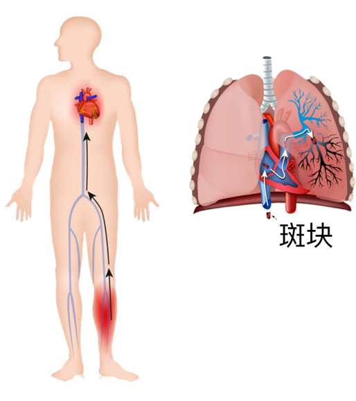 血栓是心梗、腦梗的元兇，很容易找上這些人