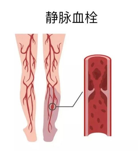 血栓是心梗、腦梗的元兇，很容易找上這些人