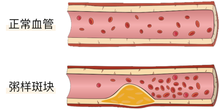 血栓是心梗、腦梗的元兇，很容易找上這些人
