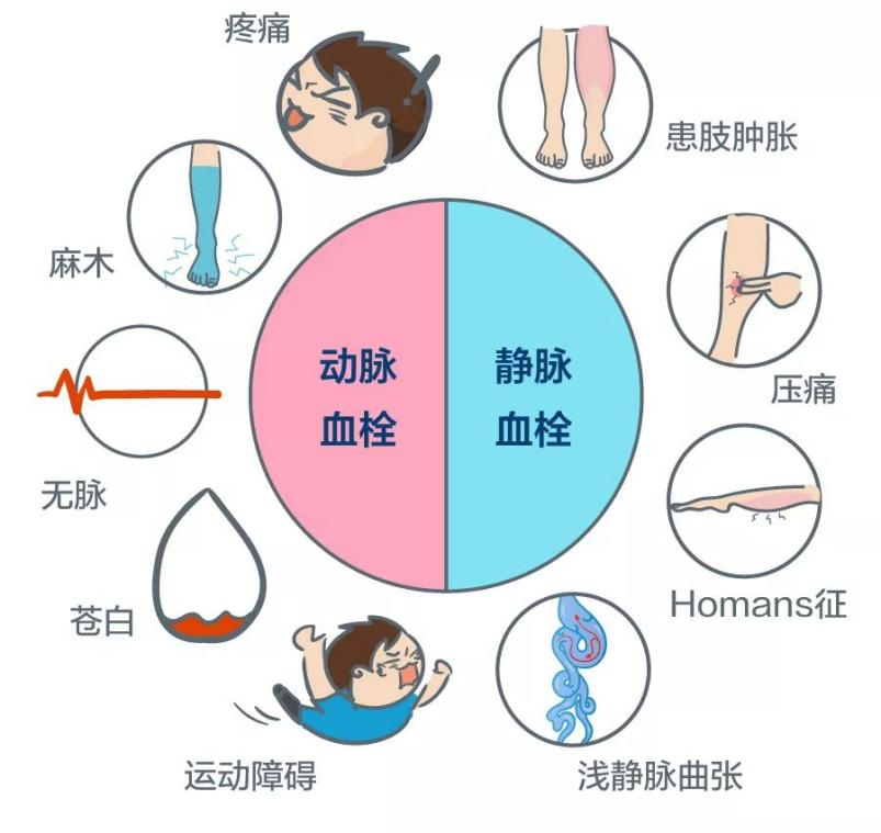 深靜脈血栓能致命，防治“大法”要了解！